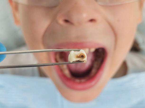Best Emergency Treatment for Toothache in Lebanon Junction, KY