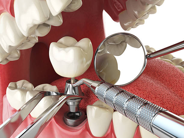 Best Emergency Broken Tooth Repair in Lebanon Junction, KY